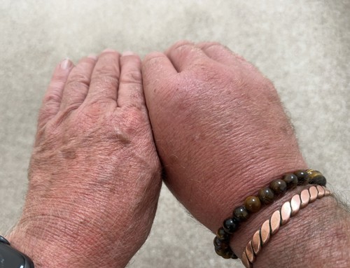 A pair of hands next to each other with one showing swelling from being stung